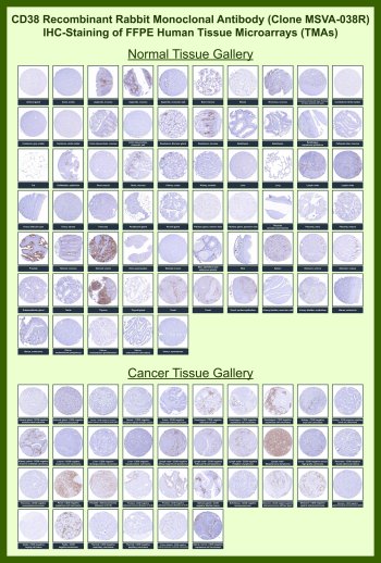 CD38 Antibody for IHC Tissue Microarray (TMA). Immunohistochemistry analysis of CD38 molecule / CD38 in formalin-fixed paraffin-embedded human normal and cancer tissue microarrays using recombinant rabbit monoclonal CD38 antibody clone MSVA-038R. Tissue microarray (TMA) staining with HRP-DAB brown chromogen demonstrates strong membranous and cytoplasmic localization in plasma cell populations within lymphoid tissues including tonsil, lymph node, and spleen, while most epithelial and stromal compartments remain largely negative. Within tumor tissue microarrays, CD38-positive tumor-infiltrating immune cells are observed with variable density, supporting evaluation of immune cell distribution in the tumor microenvironment. Evaluation across large TMA panels enables direct comparison of CD38 expression across diverse tissue types under standardized conditions. The observed staining patterns align with reported CD38 expression profiles in the Human Protein Atlas.