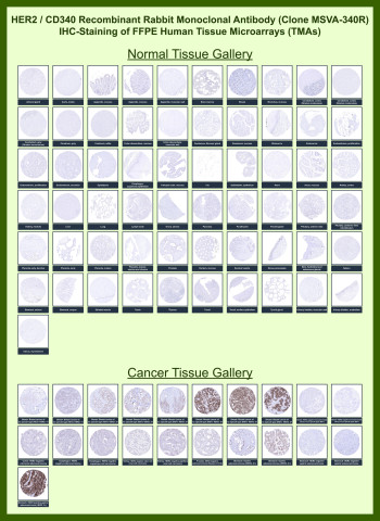 HER2 Antibody for IHC Tissue Microarray (TMA) Multi-Tissue Expression Analysis. Immunohistochemistry analysis of Receptor tyrosine-protein kinase erbB-2 (ERBB2) expression in FFPE human tissue microarray (TMA) sections using HER2 Antibody for IHC clone MSVA-340R demonstrates minimal to absent HRP-DAB brown staining across the majority of normal tissues, with only weak membranous signal in select epithelial compartments. In contrast, cancer tissue microarrays show variable to strong membranous staining in subsets of epithelial tumors, most prominently in breast and gastric carcinoma cores, consistent with HER2 overexpression in these malignancies. The staining pattern highlights clear contrast between HER2-positive tumor cells and largely negative surrounding tissues, supporting its use as a tumor-associated membrane marker in IHC-based analysis. Heat-induced epitope retrieval was performed prior to staining to ensure optimal antigen detection in FFPE sections.