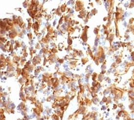 IHC analysis of FFPE human melanoma stained with Vimentin antibody (clone VIM66-1).