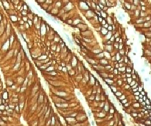 IHC testing of FFPE human colon carcinoma and EpCAM antibody (EPM17-1). FFPE testing requires sections to be boiled in pH 9 10mM Tris with 1mM EDTA for 10-20 minutes, followed by cooling at RT for 20 minutes, prior to staining.