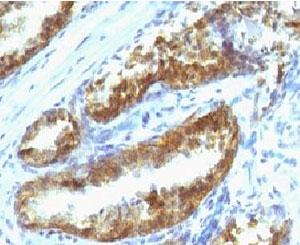 Prostate Specific Antigen Antibody Mouse Monoclonal PSAK3-1 IHC staining of human prostate carcinoma. Immunohistochemistry analysis of FFPE human prostate carcinoma tissue using Prostate Specific Antigen Antibody Mouse Monoclonal PSAK3-1 demonstrates HRP-DAB brown cytoplasmic staining in malignant prostate epithelial cells forming glandular tumor structures, consistent with Prostate specific antigen (KLK3) expression in prostate-derived carcinoma cells, while surrounding stromal cells remain largely negative. HIER: tissue sections were boiled in pH 9 10mM Tris with 1mM EDTA for 10-20 minutes followed by cooling at room temperature for 20 minutes before testing.