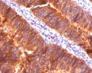 IHC testing of FFPE colon carcinoma and MUC-1 antibody (clone MCN01-1).