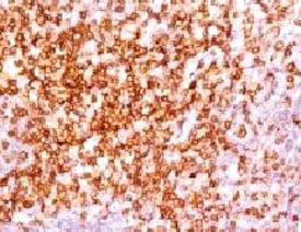 IHC analysis of human tonsil and CD6 antibody (clone CLDA6-1). Staining of formalin-fixed tissues requires boiling tissue sections in pH 9 10mM Tris with 1mM EDTA for 10-20 min followed by cooling at RT for 20 min.