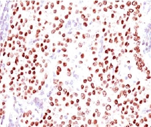 Progesterone Receptor Breast Cancer Antibody / PR Antibody (clone PGSR17) immunohistochemistry analysis of Progesterone receptor / PGR in human breast carcinoma. FFPE human breast carcinoma tissue was stained with the mouse monoclonal Progesterone Receptor Breast Cancer Antibody (clone PGSR17) following heat induced epitope retrieval by boiling sections in pH 9 10mM Tris with 1mM EDTA for 10-20 minutes and cooling at room temperature for 20 minutes prior to staining. HRP-DAB brown chromogenic signal reveals strong nuclear staining in tumor epithelial cells, consistent with the known nuclear localization of Progesterone receptor (PGR) in hormone-responsive breast cancer. PR immunohistochemistry staining is widely used in breast cancer diagnostics to evaluate progesterone receptor expression in tumor epithelial cells and to assess hormone receptor status alongside ER and HER2.