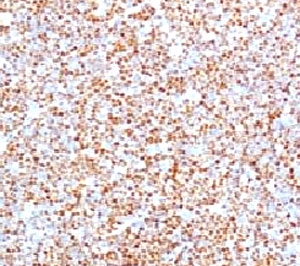 IHC testing of human mantle cell lymphoma and Cyclin D1 antibody (clone BCLD1-1).