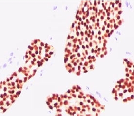 ER Antibody Breast Carcinoma IHC. Immunohistochemistry testing of human breast carcinoma stained with Estrogen receptor antibody (NR3Ga-3). FFPE testing requires boiling tissue sections in pH 9 10mM Tris with 1mM EDTA for 10-20 min and cooling at RT for 20 minutes.