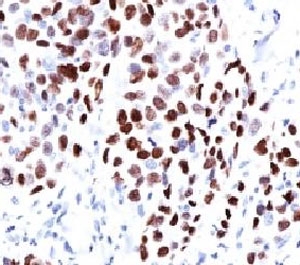 IHC testing of human lung squamous cell carcinoma (SCC) and p21 antibody (WAF21-1). Staining of formalin-fixed tissues requires boiling tissue sections in pH 9 10mM Tris with 1mM EDTA for 10-20 min followed by cooling at RT for 20 min