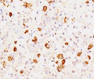 FSHB Antibody Pituitary Gonadotroph IHC. Immunohistochemistry staining of FFPE human pituitary tissue using FSHB Antibody / Pituitary Gonadotropin Hormone Antibody clone FLTPb-1 demonstrates strong granular cytoplasmic HRP-DAB brown staining in scattered anterior pituitary endocrine cells, consistent with follicle stimulating hormone beta / FSHB expression in gonadotroph-associated cellular populations. The punctate secretory staining pattern supports localization of this reproductive endocrine hormone subunit within pituitary hormone-producing cells. Staining of formalin-fixed tissues requires boiling tissue sections in pH 9 10mM Tris with 1mM EDTA for 10-20 min followed by cooling at room temperature for 20 min.
