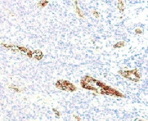 von Willebrand Factor Antibody / Megakaryocyte Lineage Marker Antibody. Immunohistochemistry analysis of human pancreas tissue shows HRP-DAB brown staining of endothelial cells lining vascular channels, with strong signal observed in vessel-associated regions. In addition to vascular endothelium, staining highlights scattered large cells consistent with megakaryocytic lineage features, supporting detection of platelet-producing cell populations. Endothelial-lined vessels and megakaryocyte-associated elements are clearly distinguished from surrounding pancreatic parenchymal cells. Clone WFA52-2 enables visualization of both vascular structures and megakaryocyte-related signal within tissue. HIER: boil tissue sections in pH 9 10mM Tris with 1mM EDTA for 10-20 min.