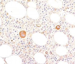 von Willebrand Factor Antibody / Megakaryocyte Lineage Marker Antibody. Immunohistochemistry analysis of human bone marrow tissue shows HRP-DAB brown staining of scattered large megakaryocytes within the hematopoietic environment, characterized by strong cytoplasmic signal in morphologically distinct cells. Additional staining is observed in endothelial cells lining marrow vascular channels. The pattern highlights platelet-producing megakaryocytic lineage cells among surrounding hematopoietic populations, clearly distinguishing them from smaller marrow cells. Clone WFA52-2 enables visualization of megakaryocytes and associated vascular structures within bone marrow. HIER: boil tissue sections in pH 9 10mM Tris with 1mM EDTA for 10-20 min.