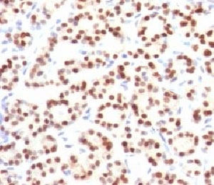 TTF-1 Antibody Human Thyroid IHC. Immunohistochemistry of TTF-1 Antibody / Pulmonary Epithelial Cell Marker Antibody in human thyroid tissue. FFPE human thyroid tissue stained using TTF-1 Antibody / Pulmonary Epithelial Cell Marker Antibody. The mouse monoclonal clone HBNK2-1 antibody demonstrates strong nuclear staining in thyroid follicular epithelial cells, consistent with the nuclear localization of Thyroid transcription factor 1 (NKX2-1). NKX2-1 is a lineage-associated transcription factor expressed in both pulmonary epithelial cells of the respiratory epithelium and thyroid follicular epithelial cells, reflecting the shared developmental origin of these epithelial tissues. Thyroid tissue therefore provides a well-established epithelial lineage control for TTF-1 antibody staining while the protein also serves as a marker of pulmonary epithelial cells, including alveolar epithelial cells within lung tissue. Required HIER: boil FFPE tissue sections in pH6 10mM citrate buffer for 10-20 minutes followed by cooling at RT for 20 minutes.