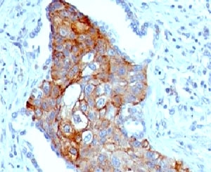 TRIM29 Antibody LSCC IHC. Immunohistochemistry testing of FFPE human lung squamous cell carcinoma and TRIM29 antibody (clone TPMP29-1). FFPE testing requires sections to be boiled in pH 9 10mM Tris with 1mM EDTA for 10-20 minutes, followed by cooling at RT for 20 minutes, prior to staining.