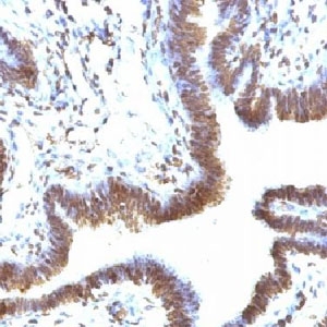EMI1 Antibody Ovarian Carcinoma IHC. Immunohistochemistry analysis of FFPE human ovarian carcinoma tissue stained with EMI1 Antibody / Mitotic Progression Regulator Antibody clone FBXP5 demonstrates strong predominantly nuclear HRP-DAB brown staining within malignant epithelial cell populations, consistent with the role of Early mitotic inhibitor 1 / FBXO5 in proliferative signaling, APC/C-associated checkpoint regulation, and mitotic progression control. The nuclear-predominant staining pattern aligns with the function of EMI1 as a cell cycle regulatory protein involved in maintenance of orderly mitotic progression and genomic stability. Staining of formalin-fixed tissues requires boiling tissue sections in pH 9 10mM Tris with 1mM EDTA for 10-20 min followed by cooling at RT for 20 min.