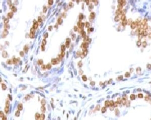 AR Antibody for IHC (clone ANDRC-1) immunohistochemistry of human prostate carcinoma. Formalin-fixed, paraffin-embedded human prostate carcinoma tissue stained with the mouse monoclonal AR Antibody for IHC (clone ANDRC-1) shows strong nuclear HRP-DAB brown chromogenic staining in malignant glandular epithelial cells, consistent with androgen receptor expression and the expected nuclear localization of this ligand-activated steroid hormone receptor. Surrounding stromal elements display minimal staining, highlighting the predominance of AR-positive tumor epithelial nuclei within the carcinoma tissue.
