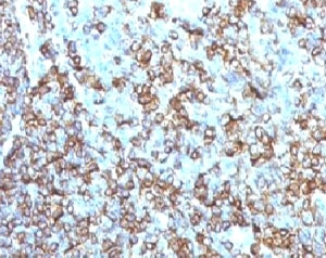 HLA-DRB1 Antibody Mouse Monoclonal MHDRb2 immunohistochemistry analysis of human tissue. IHC staining of formalin-fixed, paraffin-embedded human tonsil using HLA-DRB1 Antibody Mouse Monoclonal MHDRb2 demonstrates HRP-DAB brown membranous staining in numerous antigen-presenting immune cells within lymphoid tissue. The staining pattern highlights B lymphocytes and other immune cell populations consistent with expression of the HLA-DR beta chain / HLA-DRB1 in professional antigen-presenting cells. Heat-induced epitope retrieval was performed by boiling tissue sections in pH 9 10 mM Tris with 1 mM EDTA for 10-20 min followed by cooling at room temperature prior to antibody incubation.
