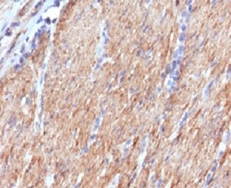 IHC testing of FFPE human colon carcinoma with SMMHC Antibody SMM11-1. FFPE testing requires sections to be boiled in pH 9 10mM Tris with 1mM EDTA for 10-20 minutes, followed by cooling at RT for 20 minutes, prior to staining.