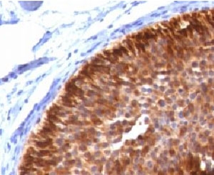 Cytokeratin 17 IHC Antibody Clone CTKN17-1 immunohistochemistry analysis of human bladder carcinoma tissue. Immunohistochemistry of FFPE human bladder carcinoma demonstrates strong HRP-DAB brown cytoplasmic staining in malignant epithelial cells using Cytokeratin 17 IHC Antibody Clone CTKN17-1. The staining highlights tumor epithelial cells consistent with the known expression pattern of Cytokeratin 17 (CK17 / KRT17), an epithelial intermediate filament protein commonly detected in stratified epithelial tissues and epithelial-derived tumors. Heat-induced epitope retrieval was performed by boiling tissue sections in pH 9 10mM Tris with 1mM EDTA for 10-20 minutes followed by cooling at room temperature for 20 minutes prior to antibody incubation.