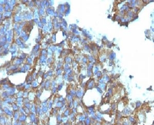 IHC testing of FFPE human ovarian carcinoma and CD99 antibody (clone CDLA99). Staining of formalin-fixed tissues requires boiling tissue sections in pH 9 10mM Tris with 1mM EDTA for 10-20 min followed by cooling at RT for 20 min.