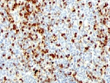 ZAP70 Antibody / Lymphocyte Differentiation and Effector Programming Antibody. Immunohistochemistry analysis of formalin-fixed, paraffin-embedded human tonsil tissue using ZAP70 Antibody / Lymphocyte Differentiation and Effector Programming Antibody (clone ZTP70-1). Cytoplasmic HRP-DAB brown staining is observed in lymphoid cell populations within tonsillar follicles and interfollicular regions, with heterogeneous staining intensity across cells. This pattern is consistent with Zeta-chain-associated protein kinase 70 (ZAP70) expression and reflects differences in signaling states associated with lymphocyte differentiation and effector programming. The distribution highlights subsets of lymphocytes undergoing distinct functional specialization, supporting the role of ZAP70 in shaping immune cell fate within lymphoid tissue architecture.