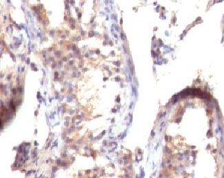 IHC testing of FFPE human testicular carcinoma with TGF alpha antibody (clone TFGFa-1). FFPE testing requires sections to be boiled in pH 9 10mM Tris with 1mM EDTA for 10-20 minutes, followed by cooling at RT for 20 minutes, prior to staining.