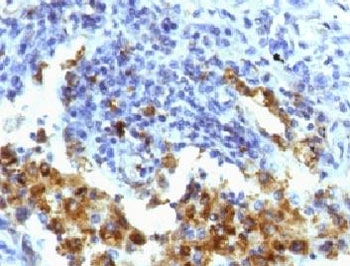 Napsin A Antibody for IHC. Immunohistochemistry analysis of Napsin A (NAPSA) expression in FFPE human lung adenocarcinoma demonstrates strong granular cytoplasmic HRP-DAB brown staining in tumor epithelial cells with minimal background in surrounding stromal regions. Clone NPSNA-1 highlights Napsin A expression consistent with its role in surfactant protein processing in alveolar epithelial cells, supporting identification of enzyme-associated epithelial differentiation within tumor tissue. HIER was performed by boiling tissue sections in pH 9 10mM Tris with 1mM EDTA for 10-20 minutes followed by cooling at RT for 20 minutes prior to staining.