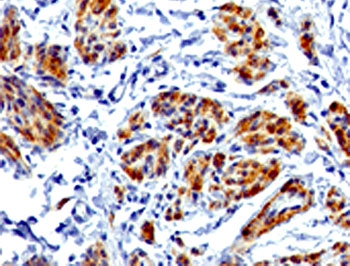 CAD Antibody / Caldesmon CALD1 Contractile Apparatus Regulatory Protein Antibody. Immunohistochemistry analysis of Caldesmon (CALD1) in human uterus tissue. FFPE human uterus stained with CAD Antibody, a rabbit monoclonal antibody, clone RMCDN1-1, demonstrates strong HRP-DAB brown cytoplasmic staining in smooth muscle cells of the myometrium. The staining highlights elongated, spindle-shaped cells with dense cytoplasmic signal consistent with contractile filament organization and actomyosin-associated structures. Surrounding stromal and epithelial cells show minimal staining, supporting specificity for smooth muscle-associated CALD1 expression. Heat-induced epitope retrieval was performed using Tris-EDTA buffer at pH9.