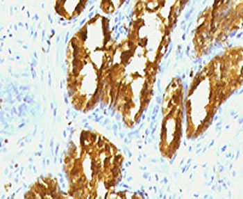 PSAP Antibody immunohistochemistry analysis of Prostatic acid phosphatase / PAP in human prostate carcinoma tissue. FFPE human prostate carcinoma tissue was stained with PSAP Antibody (mouse monoclonal, clone PSPN1-1). Heat induced epitope retrieval was performed by boiling tissue sections in pH 9 Tris-EDTA buffer (10mM Tris, 1mM EDTA) for 10-20 minutes followed by cooling at room temperature prior to staining. HRP-DAB brown chromogenic signal highlights strong cytoplasmic staining of prostate tumor epithelial cells forming glandular carcinoma structures, consistent with the known localization of Prostatic acid phosphatase (ACP3 / PAP) in prostate-derived epithelial cells. Detection of PSAP expression by immunohistochemistry is widely used in prostate cancer research and pathology studies to identify prostate epithelial lineage and evaluate Prostatic acid phosphatase expression in prostate carcinoma tissues.