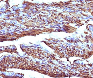 Immunohistochemistry of Calponin Antibody in human uterus. Formalin-fixed, paraffin-embedded human uterine tissue was stained using the rabbit monoclonal Calponin antibody (clone RMCN1-1), demonstrating strong cytoplasmic staining of smooth muscle cells within the myometrium, consistent with Calponin 1 expression in contractile smooth muscle fibers, while surrounding stromal and epithelial components show minimal staining. Heat-induced epitope retrieval was performed by steaming sections in 10mM Tris with 1mM EDTA, pH 9.0, for 10-20 minutes prior to testing.