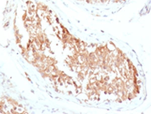 ALDH1 Antibody Testis Cancer Immunohistochemistry. IHC testing of FFPE human testicular carcinoma with ALDH1 antibody (clone AHDH1-1).