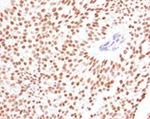 FOXA1 Antibody Human Bladder Carcinoma IHC. Immunohistochemical staining of FFPE human bladder carcinoma tissue using FOXA1 Antibody (clone FHBA1-1) demonstrates strong nuclear HRP-DAB brown staining throughout malignant epithelial cell populations. The staining pattern is consistent with expression of FOXA1, a forkhead family transcription factor that functions as a developmental regulator of gene expression, epithelial differentiation, and tissue-specific transcriptional programs. The predominantly nuclear localization is characteristic of a DNA-binding transcription factor and supports the role of FOXA1 in maintaining epithelial cellular identity and regulating lineage-specific gene expression networks. Staining of FFPE tissue is enhanced by boiling sections in 10 mM Tris with 1 mM EDTA, pH 9 for 10-20 minutes followed by cooling at room temperature for 20 minutes.