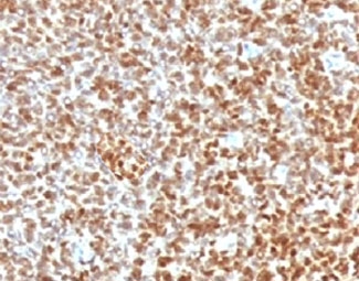 IHC testing of FFPE Ewings sarcoma with recombinant NKX2.2 antibody (clone RMNK2-1). HIER: steam sections in pH 9 10mM Tris with 1mM EDTA for 10-20 min.