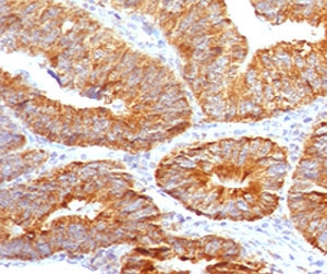 TL1A Antibody for IHC Colon Carcinoma. Immunohistochemistry of TL1A antibody in human colon carcinoma tissue. FFPE human colon carcinoma demonstrates strong membranous and cytoplasmic HRP-DAB brown staining within gland-forming tumor epithelial cells, consistent with VEGI / TNFSF15 localization in epithelial and vascular-associated compartments. Clone TLRM1-1 was used as a monoclonal antibody for detection. Heat-induced epitope retrieval was performed by boiling sections in 10 mM Tris with 1 mM EDTA, pH 9, for 10-20 minutes followed by cooling at room temperature for 20 minutes prior to staining.