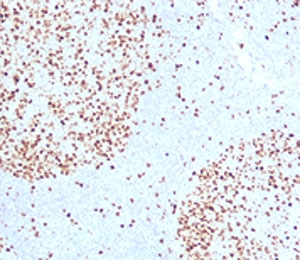 TOP2A Antibody / DNA Replication Enzyme Antibody (clone TPM2A-1). Immunohistochemistry analysis of FFPE human tonsil tissue demonstrates strong nuclear staining consistent with expression of DNA Topoisomerase II alpha, a DNA replication enzyme required for resolving topological stress during DNA synthesis. Nuclear immunoreactivity is concentrated within germinal center lymphocytes, reflecting the high DNA replication activity of these rapidly proliferating immune cells. The DNA Replication Enzyme Antibody highlights cells undergoing active DNA synthesis where replication forks generate torsional strain that must be resolved by DNA Topoisomerase II alpha. Surrounding mantle zone lymphocytes show comparatively reduced staining, consistent with lower DNA replication activity in these cells.