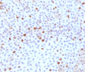 IHC testing of FFPE human bladder carcinoma with TOP2A antibody (clone TPM2A-1).