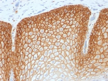 CD44v4 Antibody for IHC Cervical Squamous Cell Carcinoma. Immunohistochemistry analysis of CD44 variant 4 / CD44 expression in FFPE human cervical squamous cell carcinoma using recombinant rabbit monoclonal antibody clone CD44v4/1700R. Strong, continuous membranous HRP-DAB brown staining is observed in malignant squamous epithelial cells, clearly outlining cell borders and preserving epithelial layering consistent with CD44v4-associated cell adhesion and tissue organization. The staining pattern highlights cohesive tumor architecture and supports its use as a marker of epithelial integrity and structural organization in squamous cell carcinoma. Heat induced epitope retrieval was performed by steaming tissue sections in pH 9 10mM Tris with 1mM EDTA buffer for 20 min before testing.