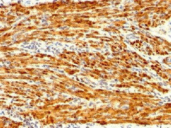 Calponin Antibody Uterus IHC. Immunohistochemistry analysis of FFPE human uterus tissue using Calponin antibody. The recombinant rabbit monoclonal antibody clone CNN1/1408R shows strong HRP-DAB brown cytoplasmic staining in smooth muscle cells of the myometrial layer, with signal distributed along contractile fibers consistent with Calponin 1 / CNN1 localization. Surrounding stromal components display minimal background staining, supporting specificity for smooth muscle-associated cytoskeletal structures. HIER: steam sections in 1 mM EDTA, pH 9, for 10-20 min followed by cooling at RT for 20 min.