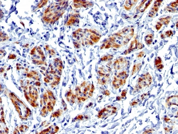 Caldesmon Antibody / CALD1 Cell Motility and Migration Regulatory Protein Antibody. Immunohistochemistry analysis of Caldesmon (CALD1) in human uterus tissue. FFPE human uterus stained with Caldesmon Antibody, clone CALD1/1424R, demonstrates strong HRP-DAB brown cytoplasmic staining in smooth muscle cells of the myometrium. The staining highlights elongated, spindle-shaped cells with organized cytoplasmic filament networks consistent with cytoskeletal remodeling and dynamic structural organization associated with cell motility and migration processes. Surrounding stromal and epithelial cells show minimal staining, supporting localization of CALD1 to cytoskeletal systems involved in regulated cellular movement. Heat-induced epitope retrieval was performed using EDTA buffer at pH9.