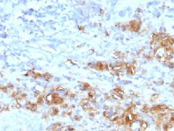 Recombinant CA19-9 Antibody Rabbit Monoclonal Gastric Carcinoma IHC. immunohistochemistry analysis of formalin-fixed paraffin-embedded human gastric carcinoma stained with Recombinant CA19-9 Antibody Rabbit Monoclonal (clone CA19.9/1390R). HRP-DAB brown chromogenic staining highlights tumor epithelial cells showing membranous and cytoplasmic CA19-9 antigen expression within the carcinoma tissue. HIER: steam sections in pH6 citrate buffer for 10-20 minutes prior to staining.