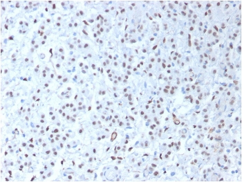 IHC testing of FFPE human mesothelioma tissue with recombinant WT1 antibody (clone WT1/1434R). HIER: steam sections in pH 9 10mM Tris with 1mM EDTA for 10-20 min.