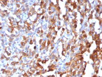 MART-1 Antibody Melanoma IHC. Immunohistochemistry testing of formalin-fixed, paraffin-embedded human melanoma stained with recombinant MART-1 antibody (clone MLANA/1409R). HIER: steam sections in pH 9 10mM Tris with 1mM EDTA for 10-20 min followed by cooling at RT for 20 min.