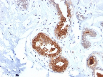 Mammaglobin Antibody Rabbit Monoclonal MGB/2123R immunohistochemistry of human breast carcinoma. FFPE human breast carcinoma tissue was stained with Mammaglobin Antibody Rabbit Monoclonal (clone MGB/2123R). HRP-DAB brown chromogenic signal highlights cytoplasmic staining in clusters of tumor epithelial cells forming glandular structures, consistent with Mammaglobin A / SCGB2A2 expression in breast carcinoma cells, while surrounding stromal cells and connective tissue elements show minimal staining. Heat-induced epitope retrieval was performed by boiling tissue sections in 10mM citrate buffer (pH6) for 10-20 minutes followed by cooling at room temperature prior to staining.