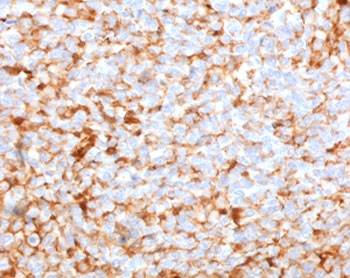 Recombinant Mammaglobin A Antibody MMGA-1R immunohistochemistry of human breast carcinoma. FFPE human breast carcinoma tissue was stained with Recombinant Mammaglobin A Antibody (clone MMGA-1R). HRP-DAB brown chromogenic signal highlights cytoplasmic staining in tumor epithelial cells distributed throughout the carcinoma tissue, consistent with expression of Mammaglobin A / SCGB2A2 in breast carcinoma cells, while surrounding stromal elements show minimal staining. Heat-induced epitope retrieval was performed by boiling tissue sections in 10mM citrate buffer (pH6) for 10-20 minutes followed by cooling prior to testing.