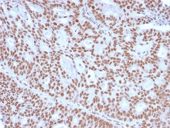 Progesterone Receptor Antibody IHC. Immunohistochemistry analysis of Progesterone Receptor Antibody - Protein Microarray Validated clone PGR/2694 in human endometrial carcinoma tissue. FFPE human endometrial carcinoma tissue was stained with the mouse monoclonal Progesterone Receptor antibody (clone PGR/2694) following heat induced epitope retrieval by boiling sections in pH6 10mM citrate buffer for 10-20 minutes. HRP-DAB brown chromogenic signal reveals strong nuclear staining in tumor epithelial cells, consistent with the known nuclear localization of Progesterone receptor (PGR) in hormone-responsive endometrial carcinoma cells.