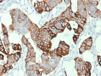 CK20 Antibody for IHC (clone KRT20/1993). Immunohistochemistry analysis of human colon carcinoma tissue using mouse monoclonal CK20 antibody (clone KRT20/1993). HRP-DAB brown chromogenic staining highlights cytoplasmic Keratin 20 / Cytokeratin 20 (KRT20) expression in malignant epithelial cells forming glandular structures, while surrounding stromal cells remain largely negative. The staining pattern reflects the known epithelial localization of this intermediate filament protein in colorectal carcinoma. Required HIER: boil tissue sections in 10 mM citrate buffer, pH 6, for 10-20 min followed by cooling at RT for 20 min.
