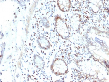 RAD51 Antibody Colon Carcinoma IHC. Immunohistochemical staining of FFPE human colon carcinoma demonstrates RAD51 expression using a RAD51 antibody. RAD51, also known as RAD51 Recombinase, is a DNA repair protein that mediates homologous recombination and preserves genomic stability following DNA damage. Predominantly nuclear staining is observed in tumor cells, consistent with the role of RAD51 in DNA double strand break repair and the elevated DNA repair activity frequently seen in proliferating cancers. Heat induced epitope retrieval was performed by boiling tissue sections in pH6 10 mM citrate buffer for 10 to 20 minutes followed by cooling prior to staining. These results support the utility of RAD51 Antibody for investigating DNA damage responses, homologous recombination, and therapeutic resistance in human malignancies.
