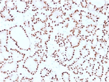 IHC staining of FFPE human thyroid carcinoma with Cyclin D1 antibody (clone CCND1/2593). HIER: boil tissue sections in pH6, 10mM citrate buffer, for 10-20 min and allow to cool before testing.