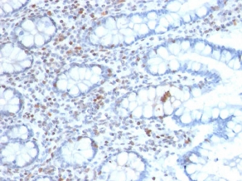 BMI1 Antibody Colon Carcinoma IHC. Immunohistochemistry testing of FFPE human colon carcinoma with BMI1 antibody (clone BMI1/2689). HIER: boil tissue sections in pH 9 10mM Tris with 1mM EDTA for 10-20 min followed by cooling at RT for 20 min.