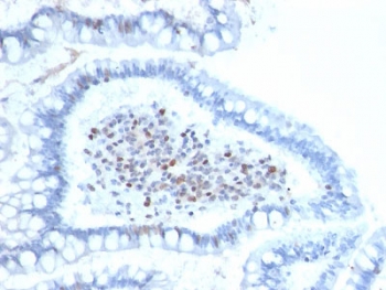 BMI1 Antibody FFEP Human Colon Carcinoma IHC. Immunohistochemistry testing of FFPE human colon carcinoma with BMI1 antibody (clone BMI1/2689). HIER: boil tissue sections in pH 9 10mM Tris with 1mM EDTA for 10-20 min followed by cooling at RT for 20 min.