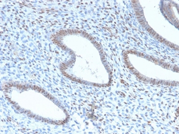 TLE1 Antibody / Transducin-Like Enhancer Protein 1 immunohistochemistry analysis of human endometrial carcinoma using clone TLE1/2946R. Formalin-fixed paraffin-embedded human endometrial carcinoma tissue shows nuclear staining in tumor cells consistent with expression of Transducin-Like Enhancer Protein 1, a nuclear Groucho family transcriptional corepressor. TLE1 protein localization is primarily nuclear, reflecting its role in transcriptional repression complexes that regulate developmental signaling pathways including Notch and Wnt. The recombinant rabbit monoclonal clone TLE1/2946R antibody highlights nuclear staining within malignant epithelial cells while surrounding stromal elements show weaker or absent staining. Heat-induced epitope retrieval was performed by boiling tissue sections in pH 9 Tris-EDTA buffer for 10-20 minutes followed by cooling prior to antibody staining.