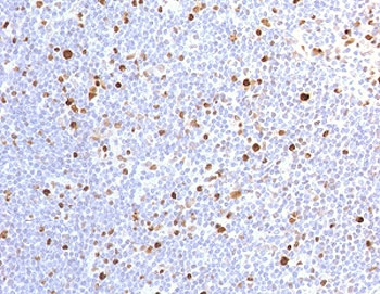 MCM7 Antibody Recombinant Rabbit MAb MMCC7-1R - immunohistochemistry of human lymph node tissue. FFPE human lymph node tissue was stained with MCM7 Antibody Recombinant Rabbit MAb MMCC7-1R to detect Minichromosome maintenance protein 7 / MCM7. HRP-DAB brown chromogenic signal highlights predominantly nuclear staining in scattered lymphoid cells within the lymph node parenchyma, consistent with the nuclear localization of this DNA replication licensing factor in proliferating cells. Hematoxylin counterstain marks cell nuclei (blue). Heat-induced epitope retrieval was performed by boiling tissue sections in pH 9 10mM Tris with 1mM EDTA for 10-20 minutes prior to staining.